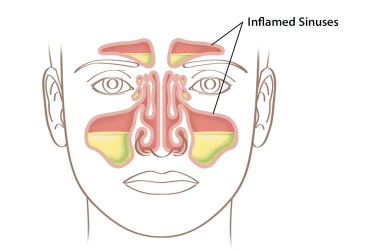 Nasal and sinus treatment